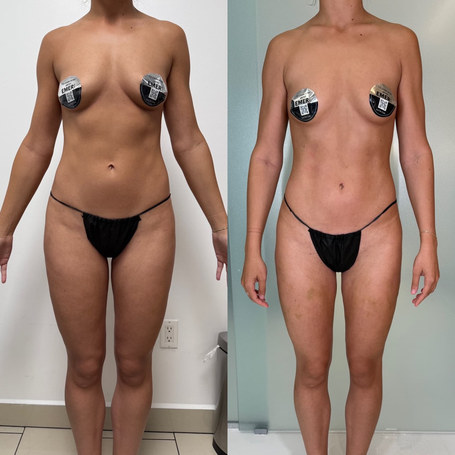 CELESTA™ Body Before and After