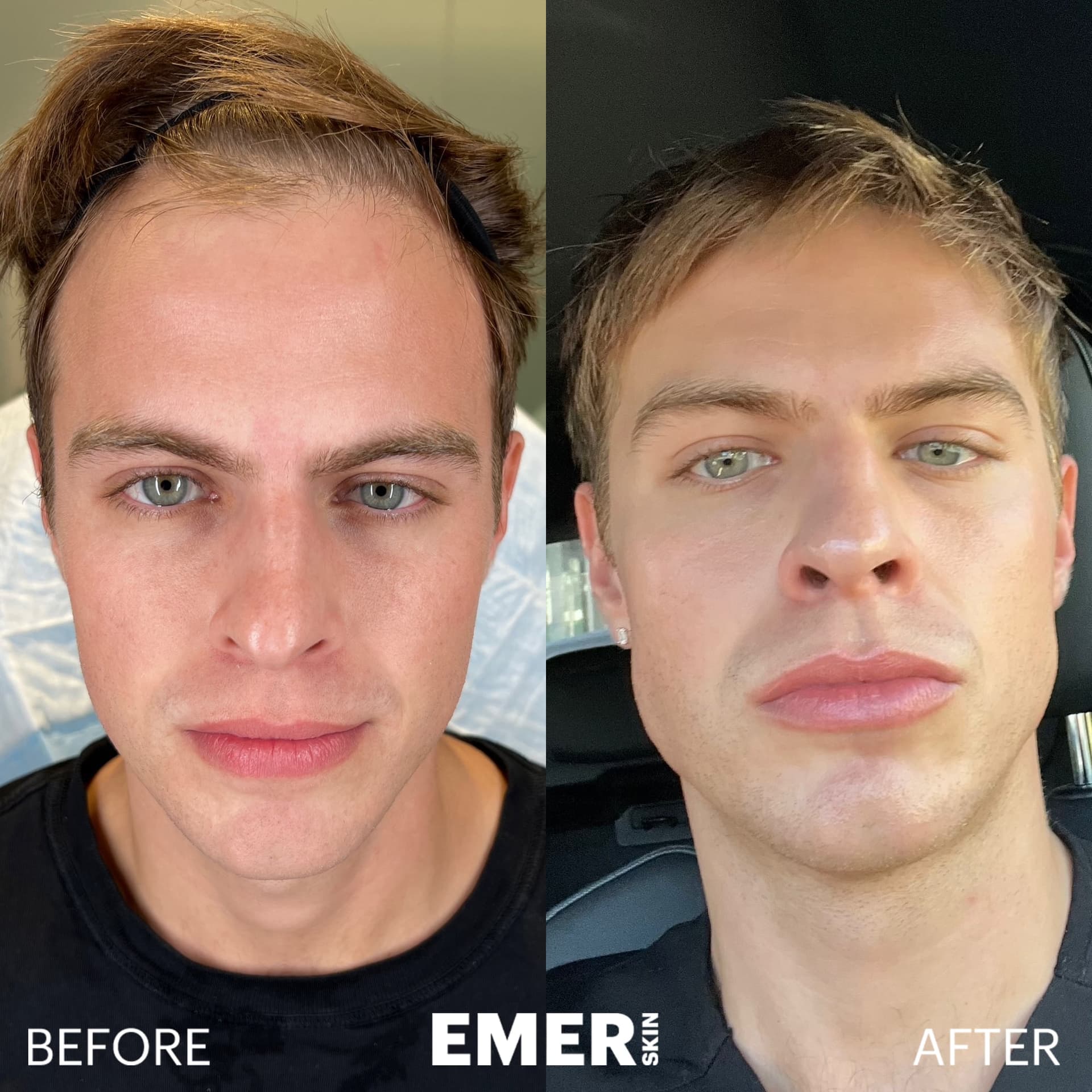 MAXORIS™ Face Before and After