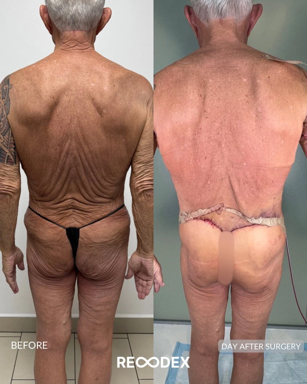 MAXORIS Body Sculpting — before and after