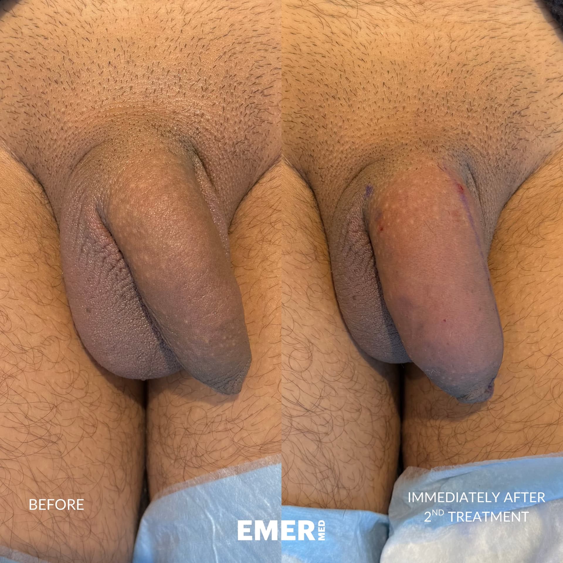 Male Enhancement — before and after