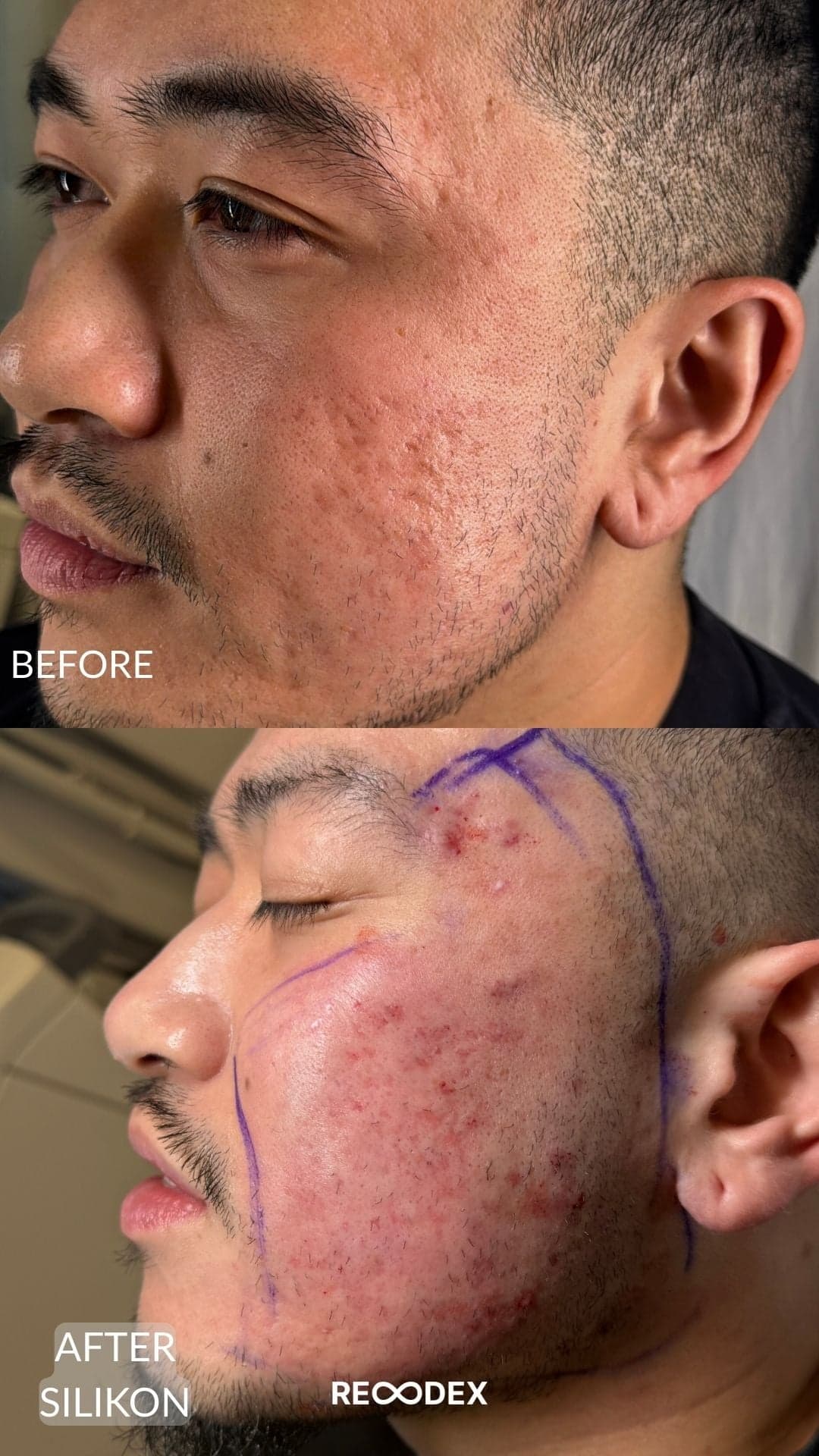 Acne Scar Treatment — before and after