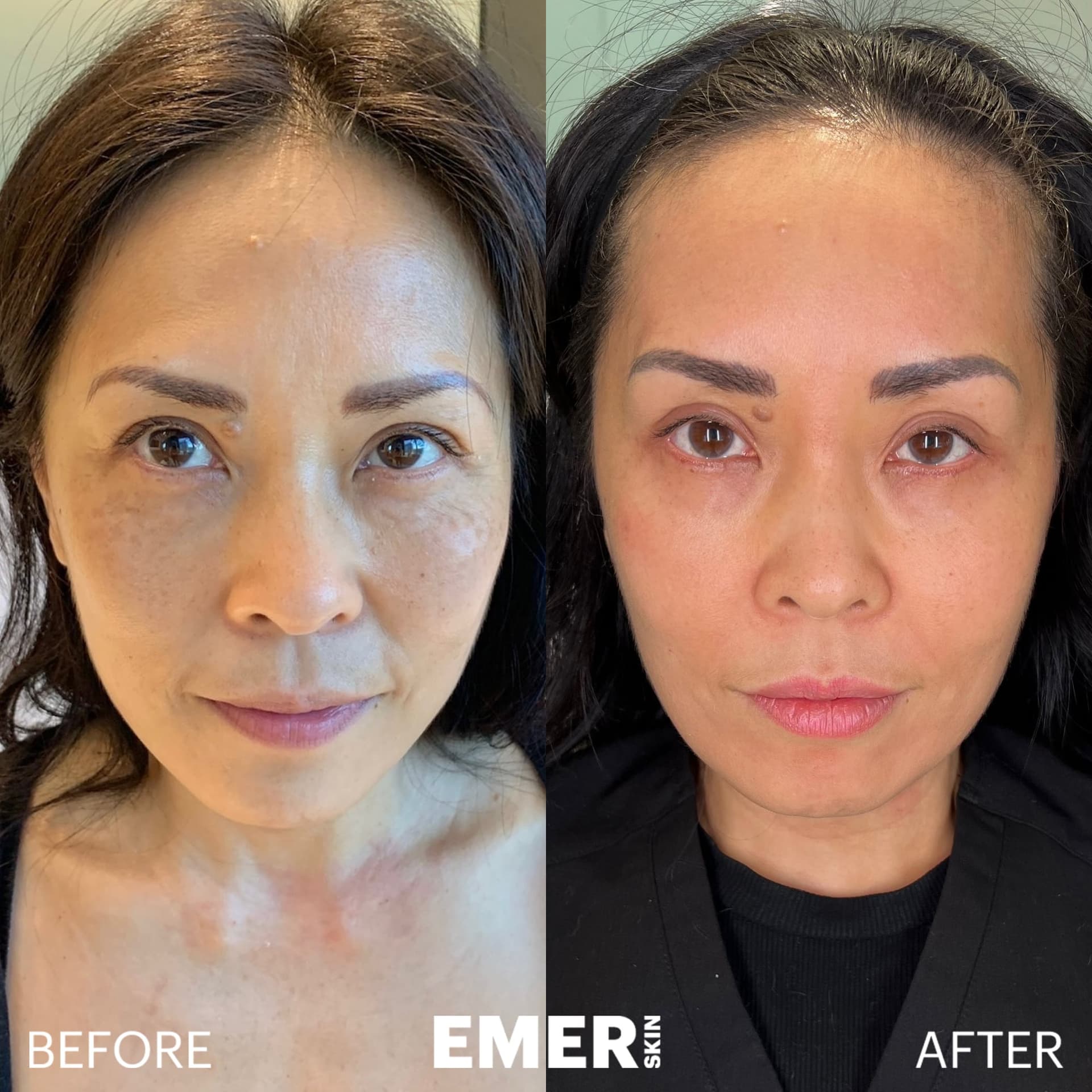 AETHRAFORM™ Reconstruction Before and After