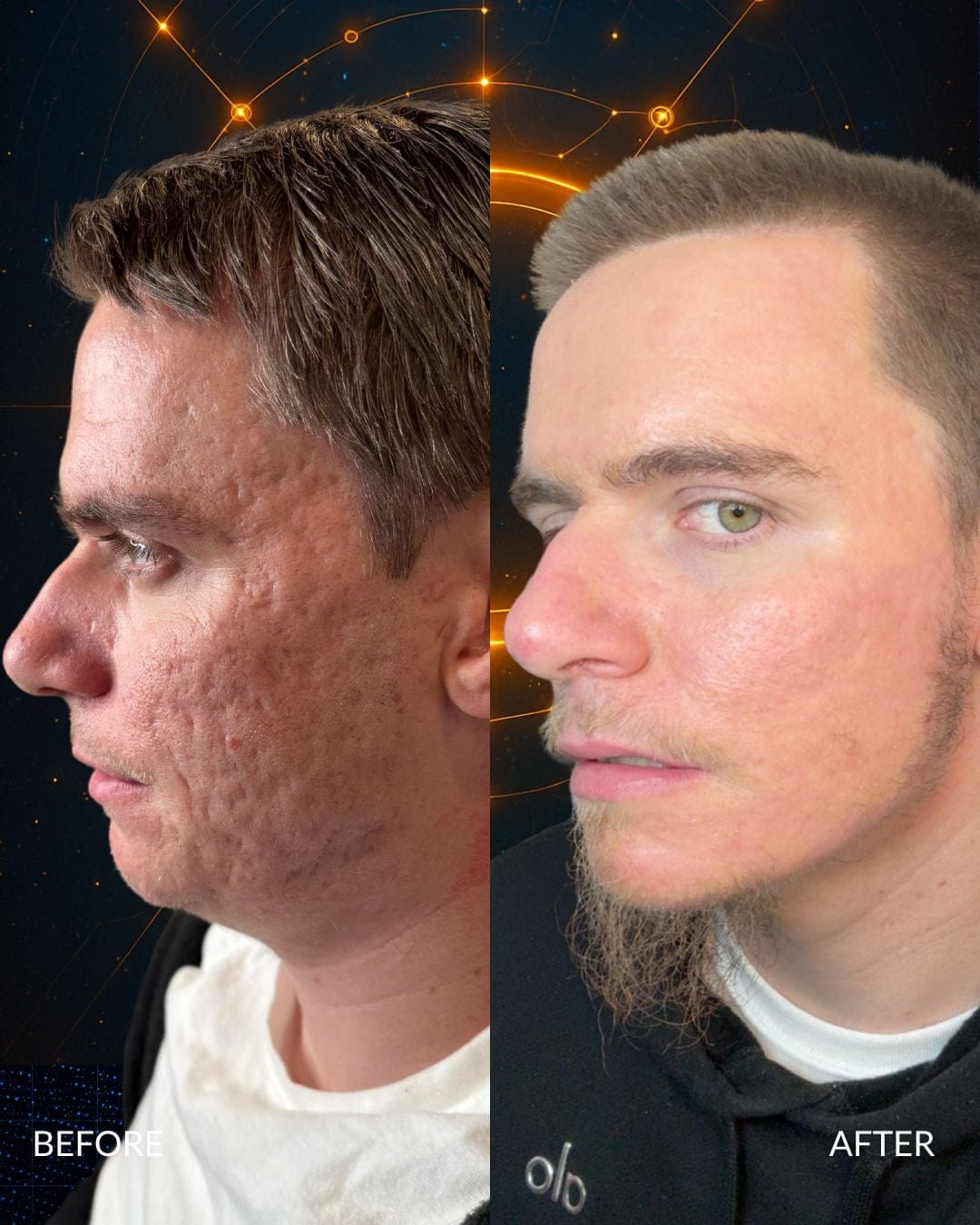 Acne Scar Treatment Before and After