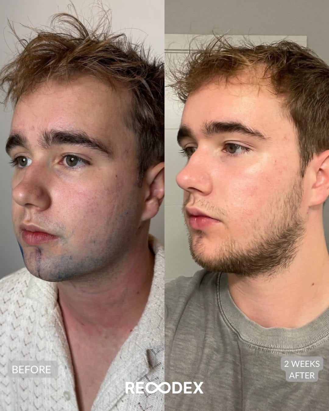 Male Facial Sculpting Before and After