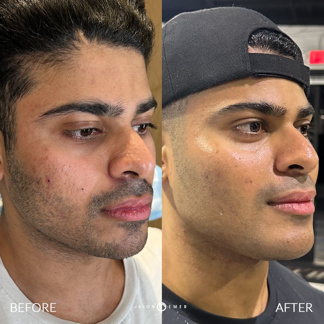 Male Facial Sculpting Before and After